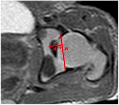 A Preliminary Cadaveric MRI Study of Fetal Hip Development